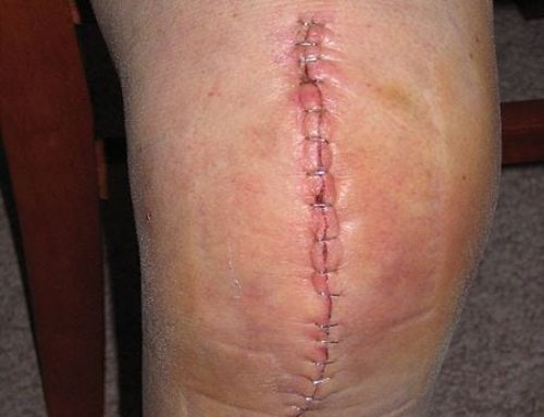 Drainage lymphatique et prothèse totale du genou