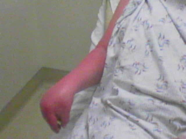 Image algodystrophie réflexe aigue