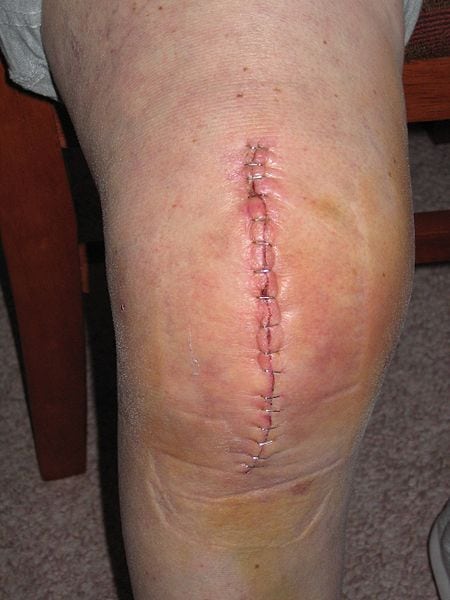 image d'une arthroplastie du genou