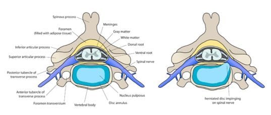hernie discale