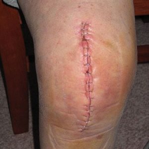 image d'une arthroplastie du genou