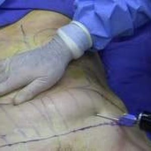 Image-de-la-liposuction-abdominale