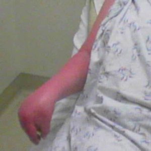 Image algodystrophie réflexe aigue