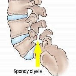 Spondylolyse2